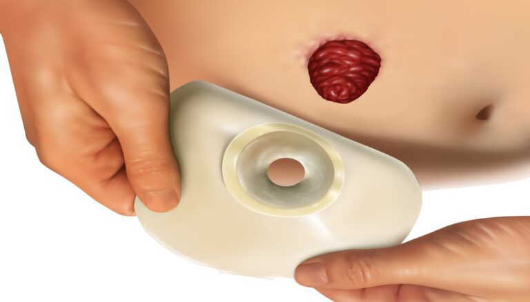 Tips Merawat Stoma Agar Kulit Tetap Sehat dan Nyaman